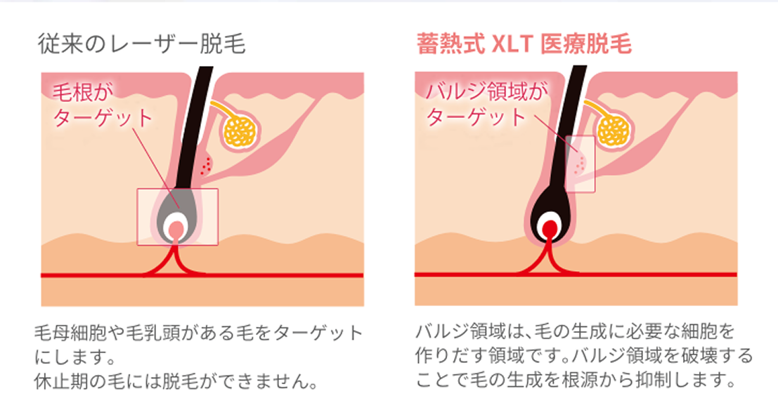 医療脱毛器のイメージ