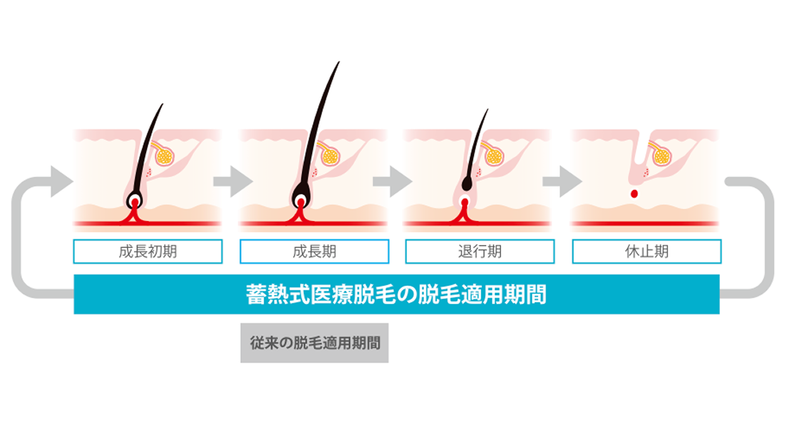 医療脱毛の施術イメージ